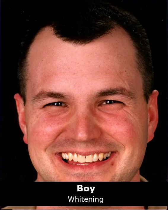 26877 teeth whitening before after