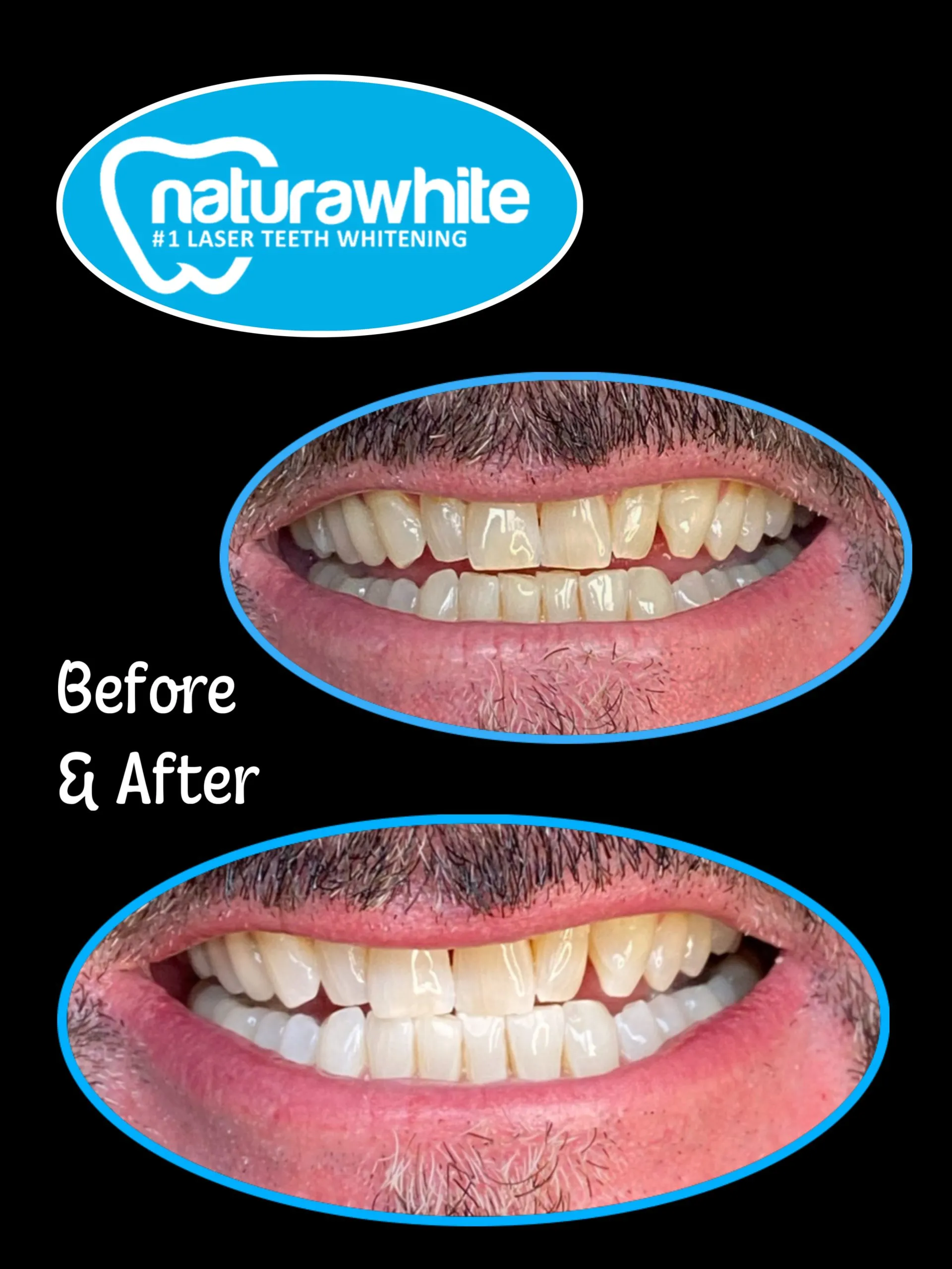 26878 laser teeth whitening