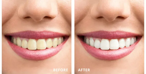 26878 teeth whitening candidate