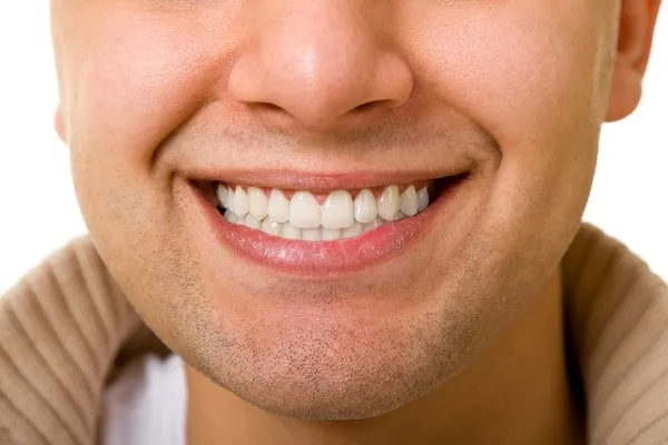 26884 teeth whitening results