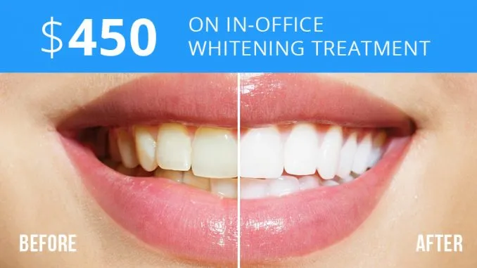 26886 in office whitening