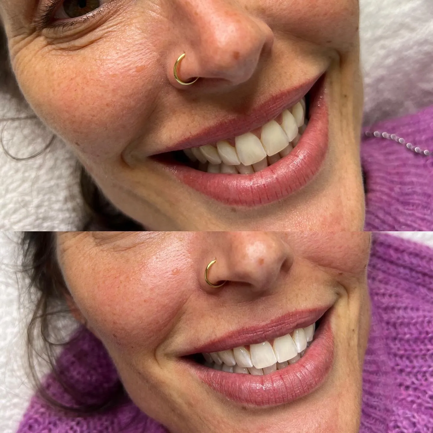 26893 Seminyak dentist teeth whitening