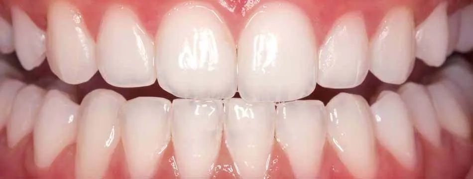 26893 Seminyak smile maintenance