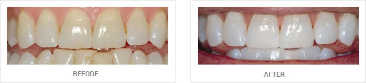 /img/26893-Seminyak-teeth-whitening-review.webp