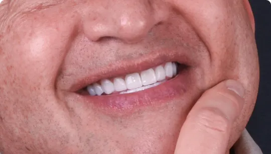26893 teeth whitening Seminyak cost