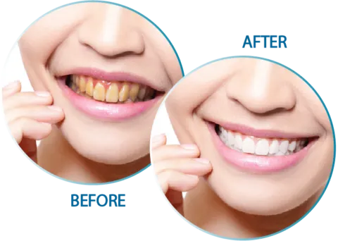 26893 teeth whitening Seminyak options