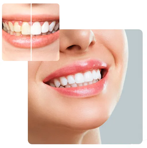 26893 teeth whitening Seminyak procedure