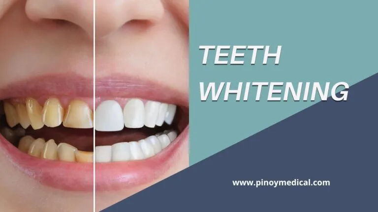 26895 at home teeth whitening kits