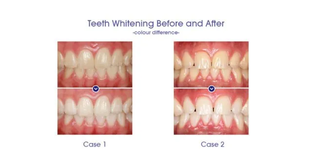 26898 teeth whitening results