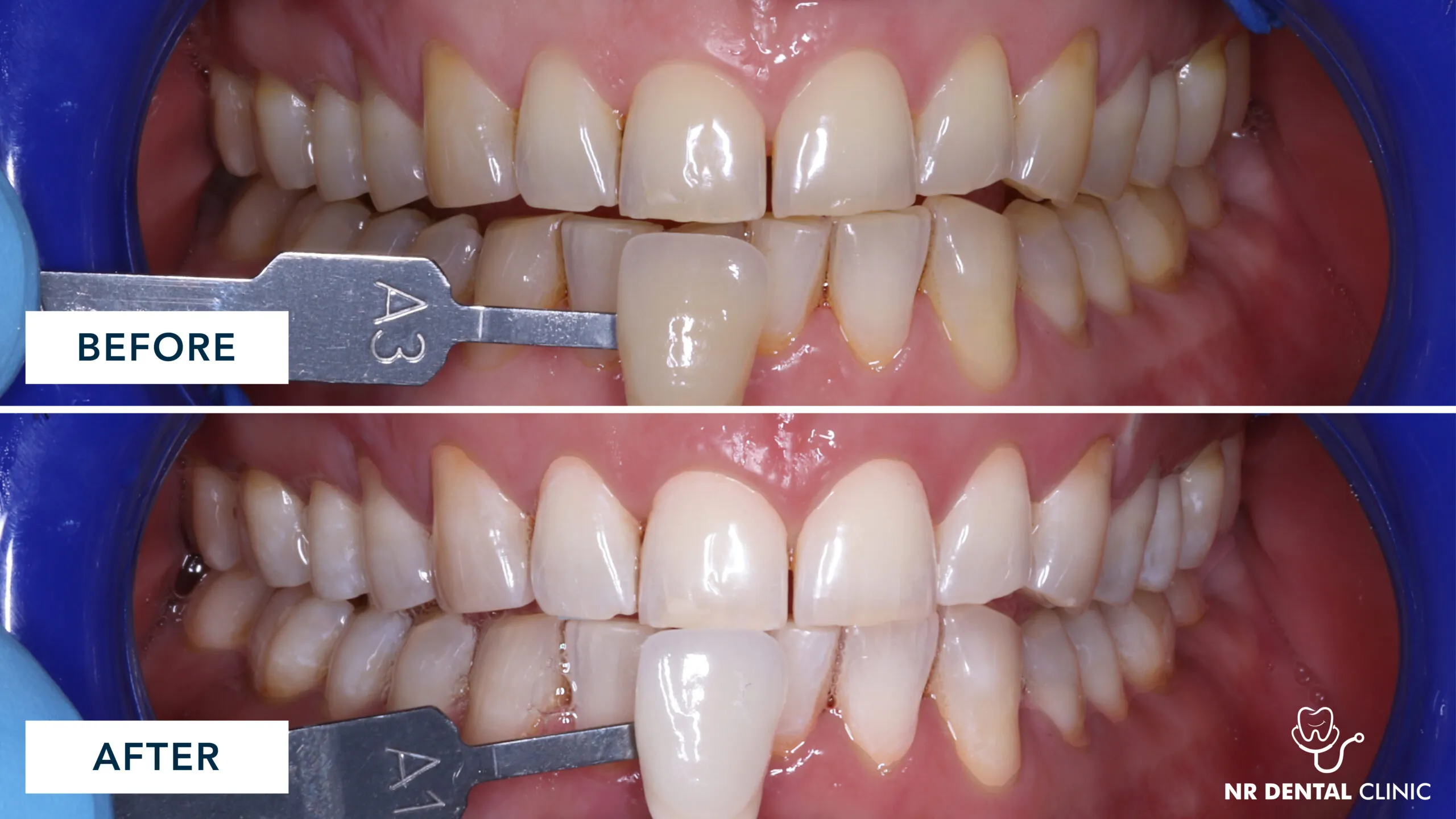 26899 invisalign aligners