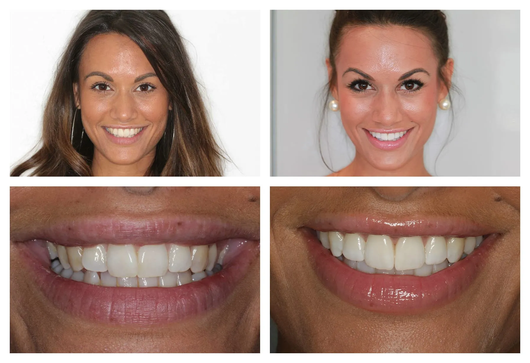 26899 teeth whitening methods