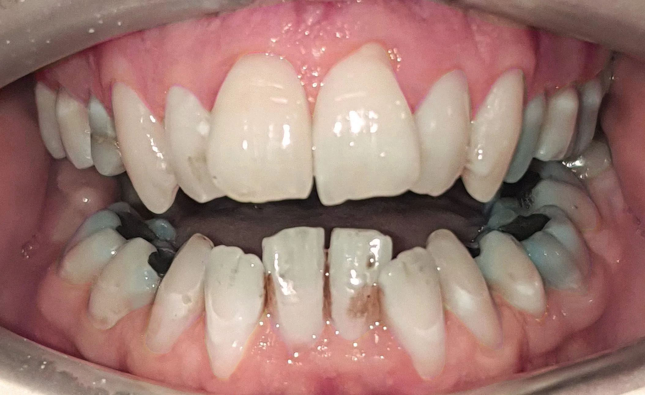 /img/26899-white-smile-invisalign.webp