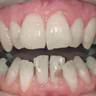 /img/26899-white-smile-invisalign.webp