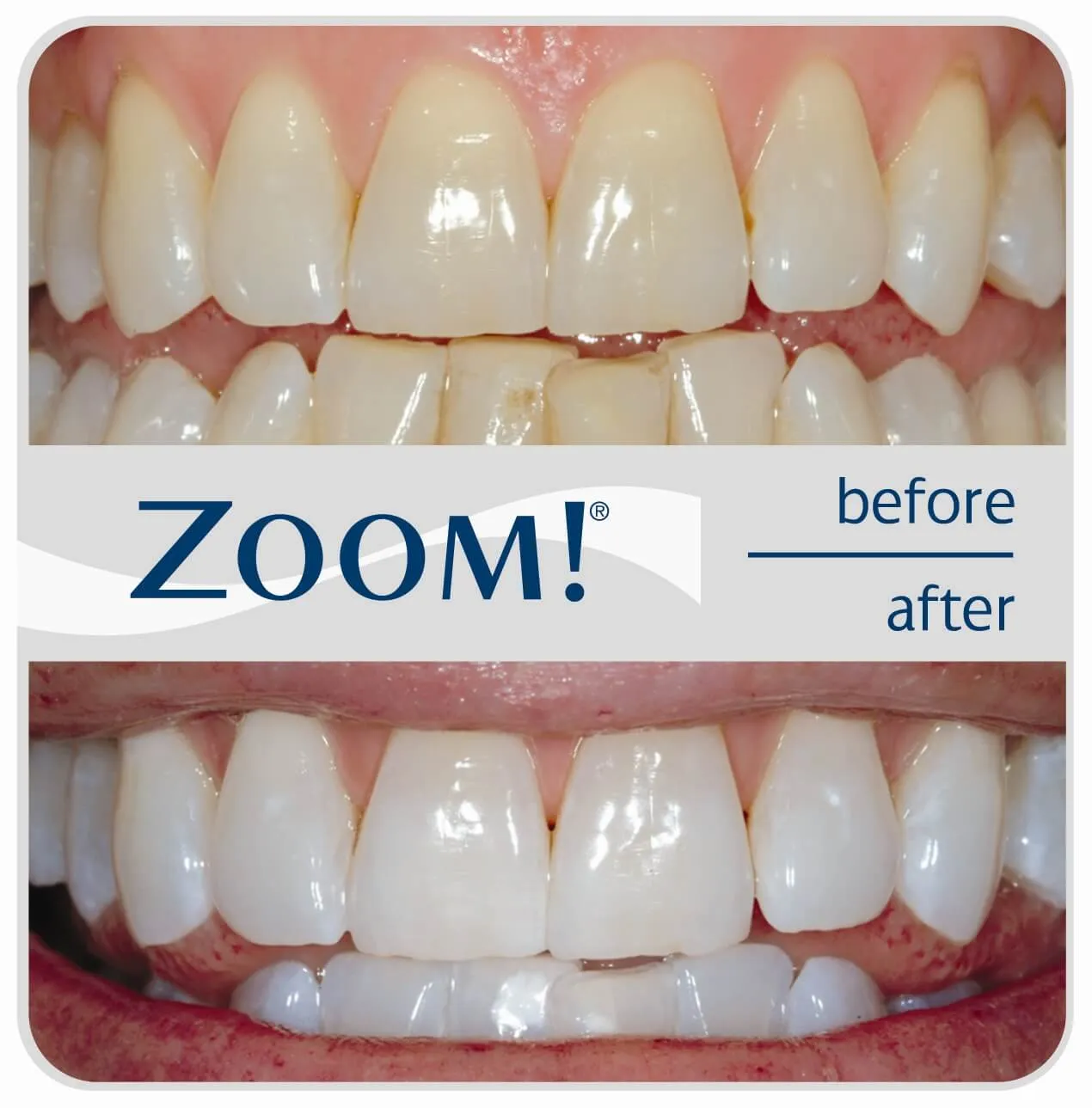 26900 in office teeth whitening
