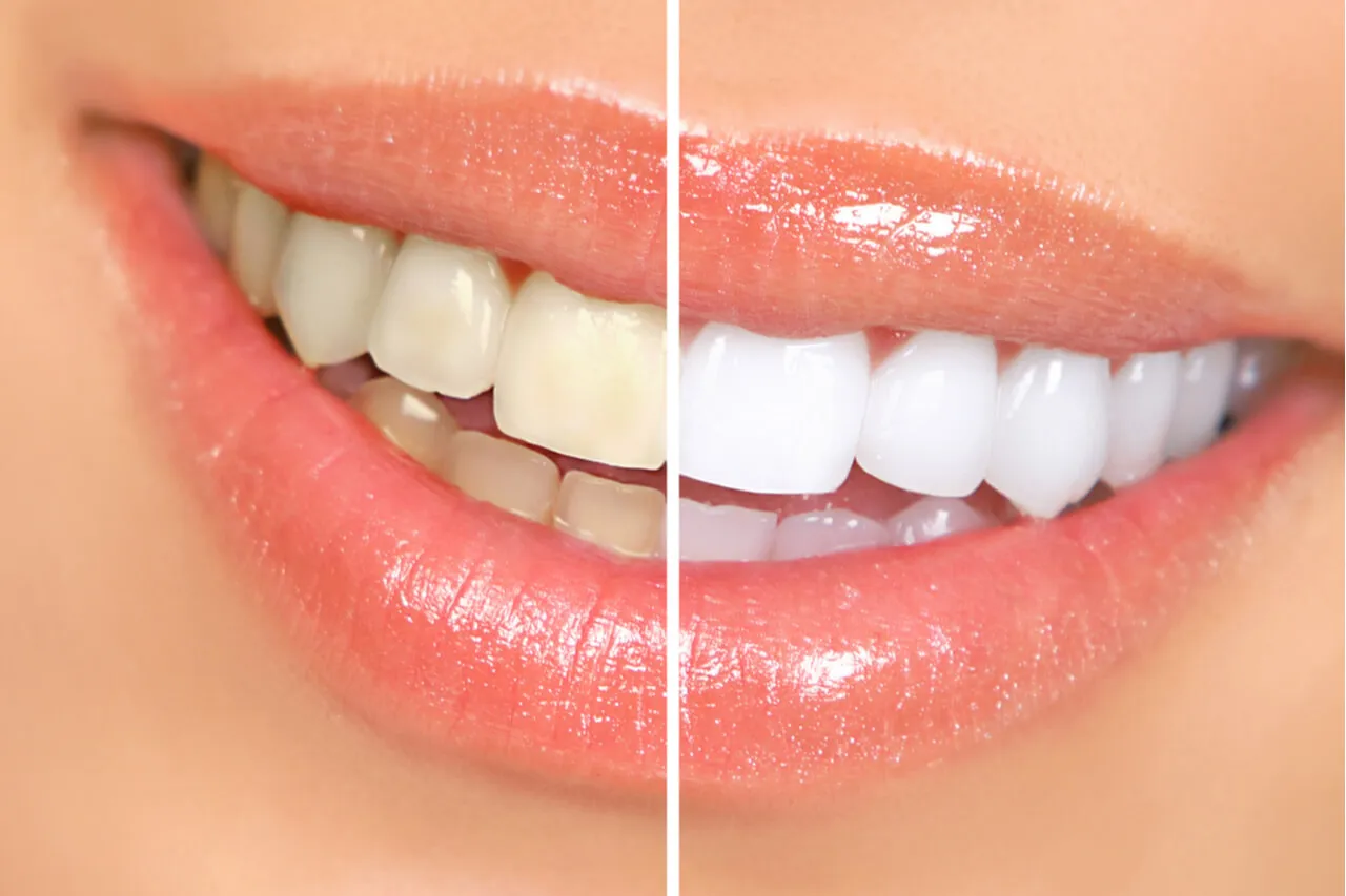 26900 teeth whitening budgeting