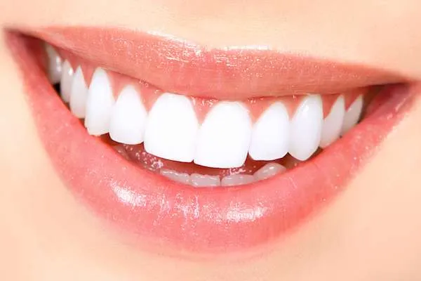 26902 in office teeth whitening