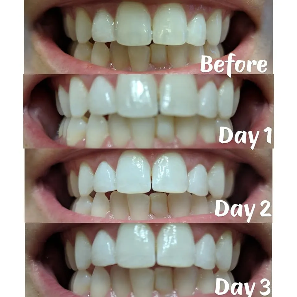 26905 teeth whitening before after