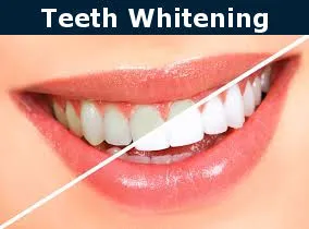 26911 burbank teeth whitening 2
