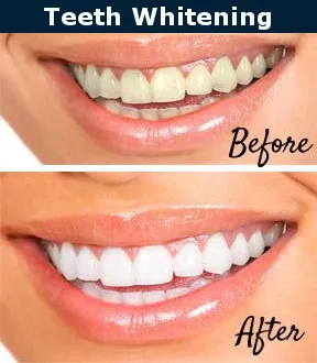 26911 burbank teeth whitening 4
