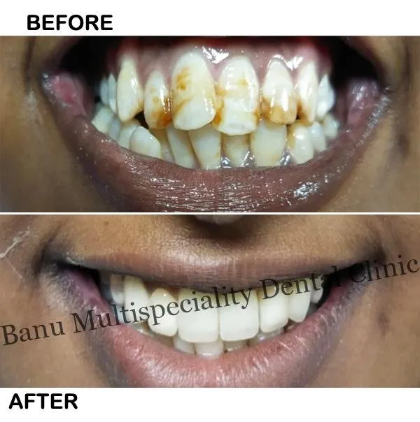 26911 burbank teeth whitening 5
