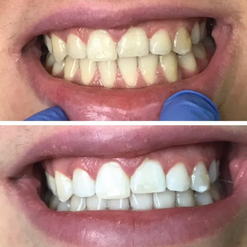 26911 burbank teeth whitening 6