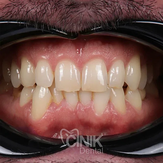/img/26911-burbank-teeth-whitening-8.webp