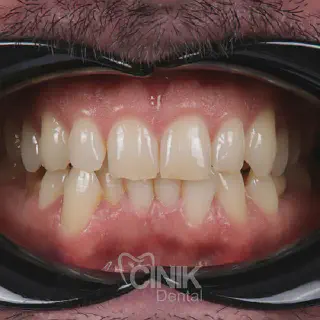 /img/26911-burbank-teeth-whitening-8.webp