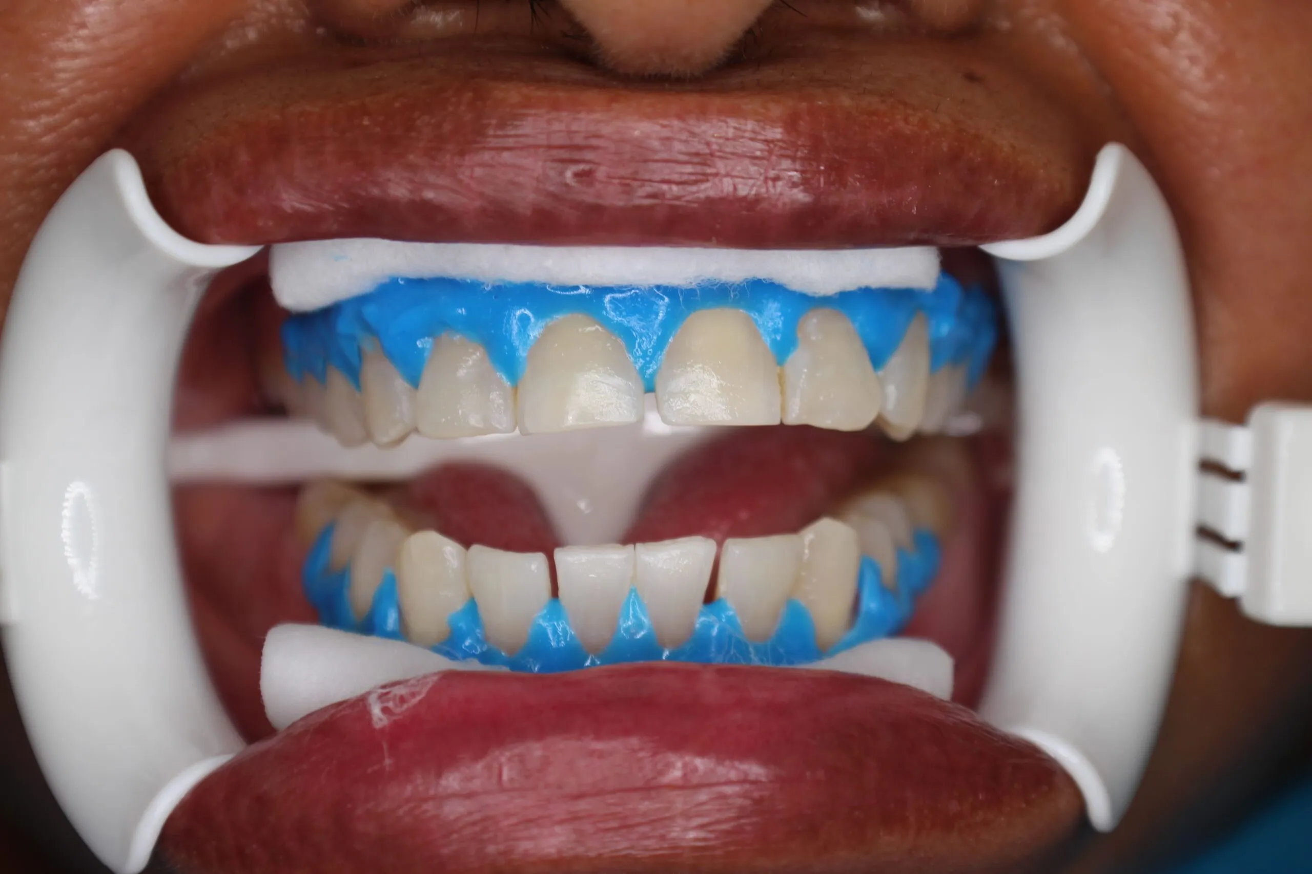 26912 teeth whitening warrington cost