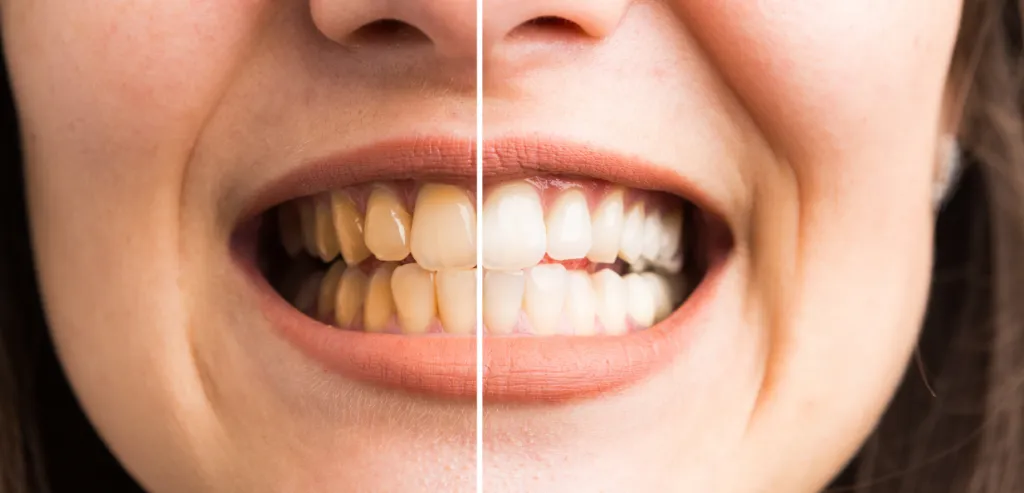 26912 teeth whitening warrington dentist
