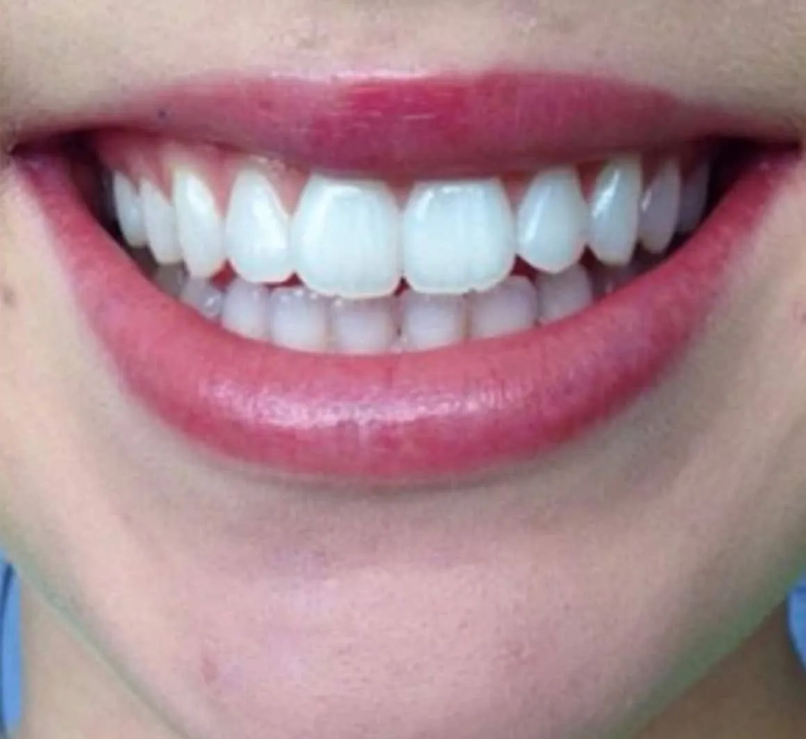 /img/26912-teeth-whitening-warrington-maintenance.webp
