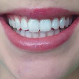 /img/26912-teeth-whitening-warrington-maintenance.webp