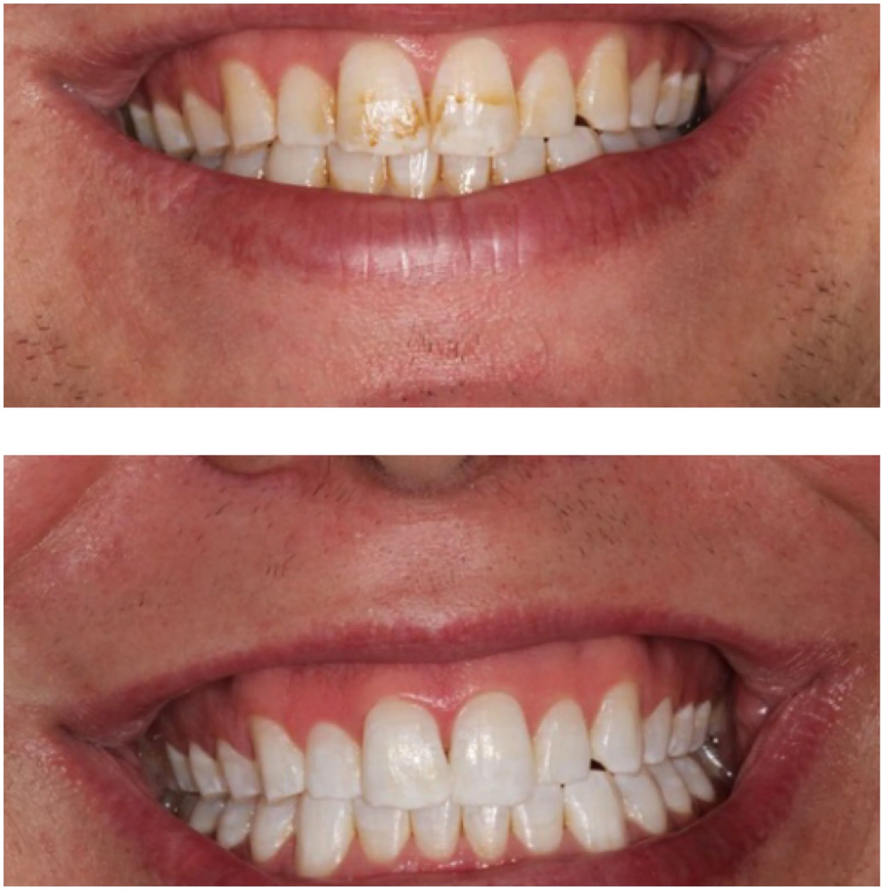 26915 teeth whitening food guide