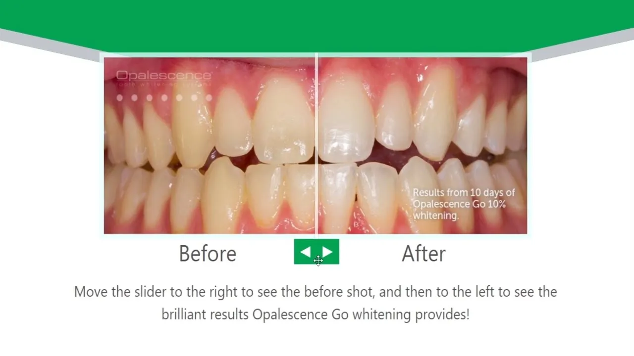 26918 teeth sensitivity during whitening