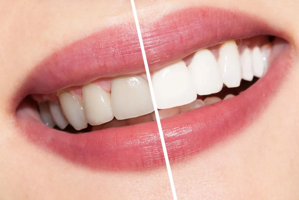 26926 teeth whitening cheam oral hygiene