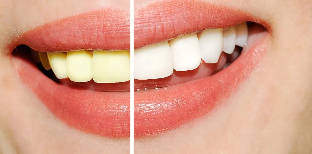 26926 teeth whitening cheam professional
