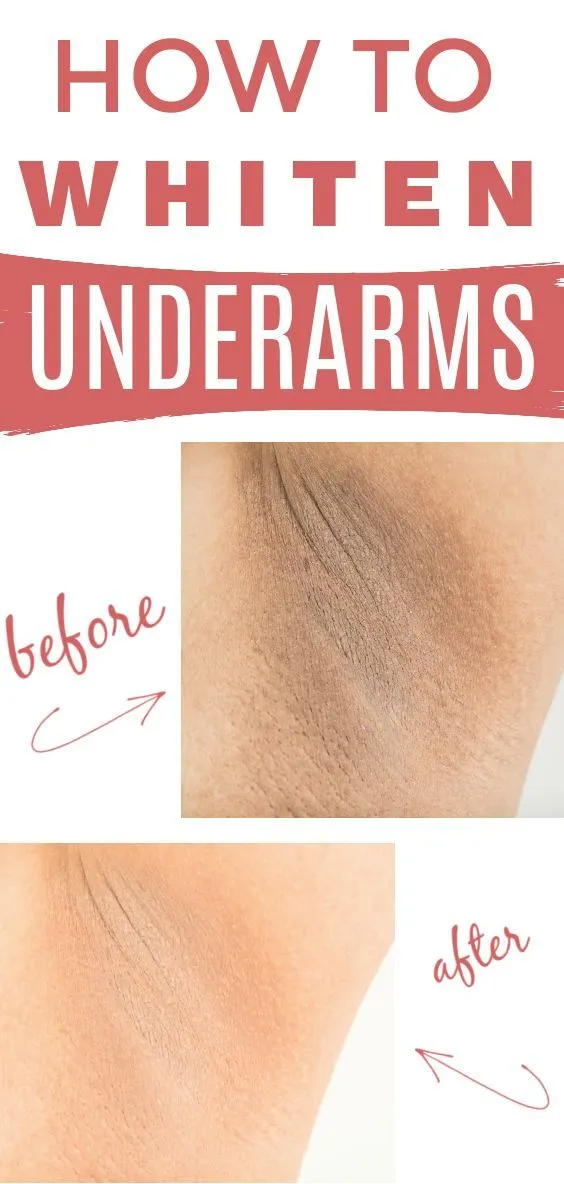 26929 armpit whitening before after