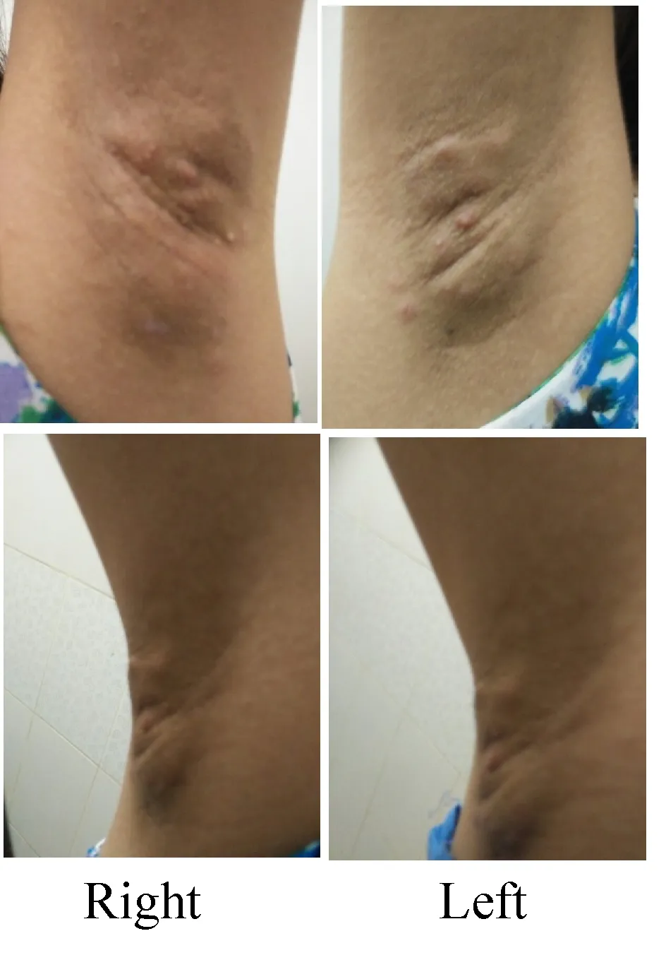 26929 baking soda exfoliation