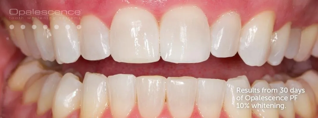 26932 opalescence whitening professional application