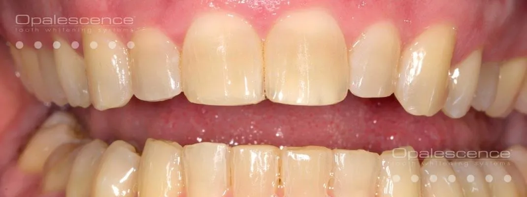 26932 opalescence whitening smile transformation