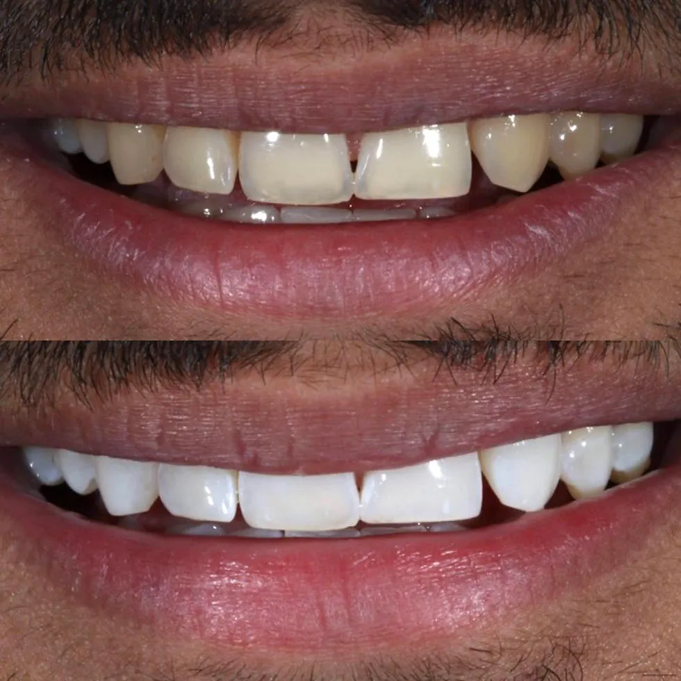 26933 at home whitening