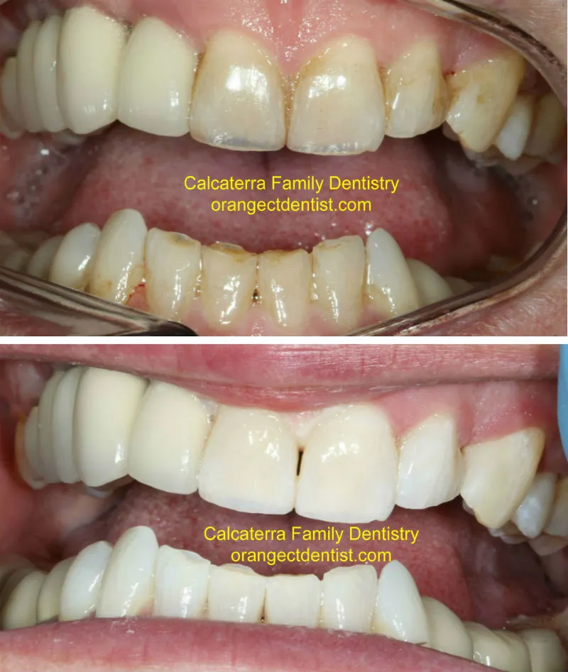 26938 teeth whitening ct image6