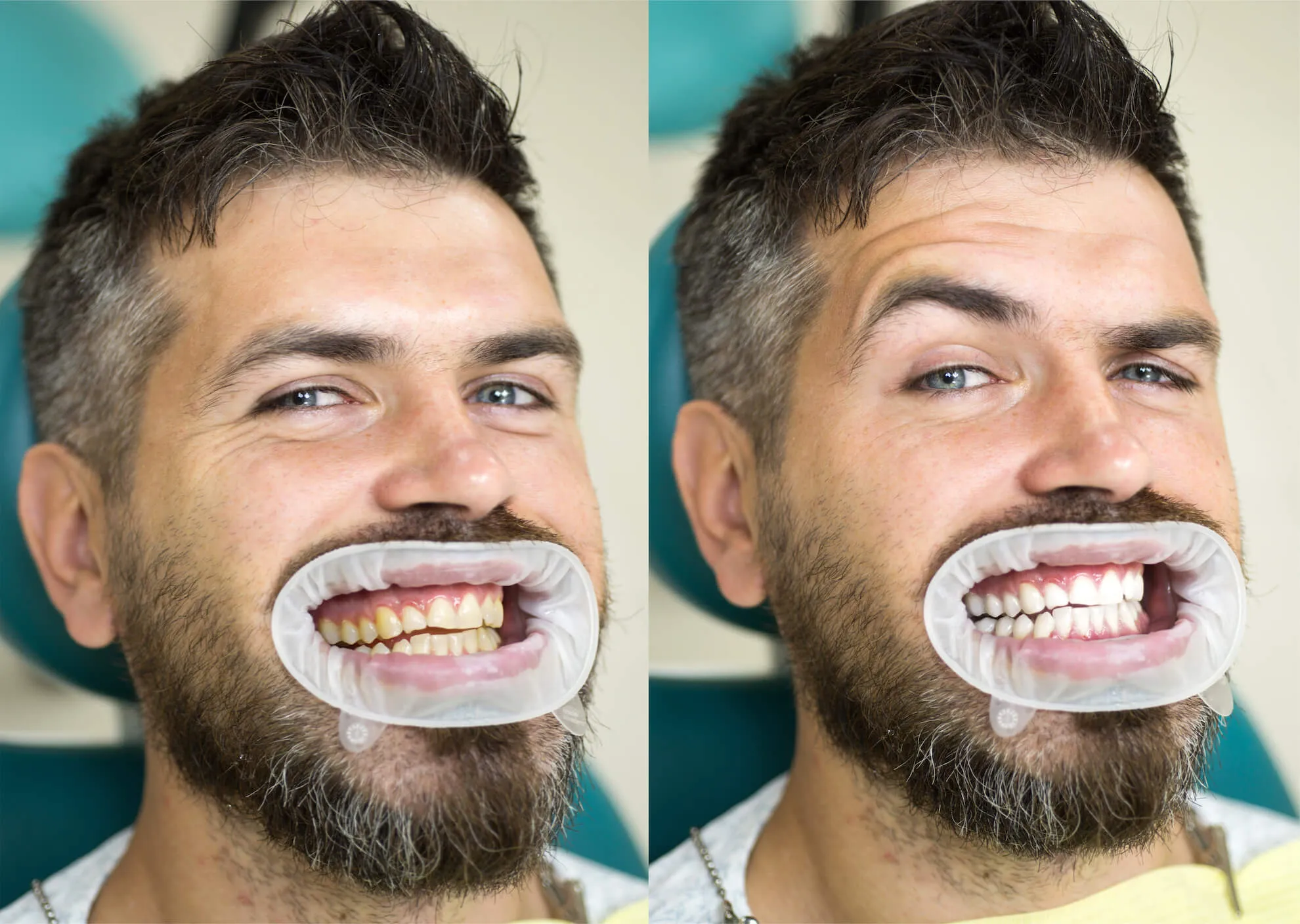 26938 teeth whitening ct image7