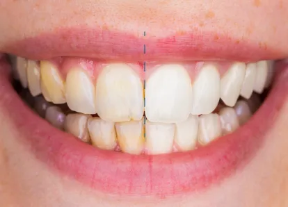 /img/26938-teeth-whitening-ct-image8.webp