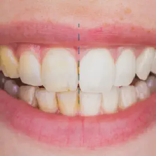 /img/26938-teeth-whitening-ct-image8.webp