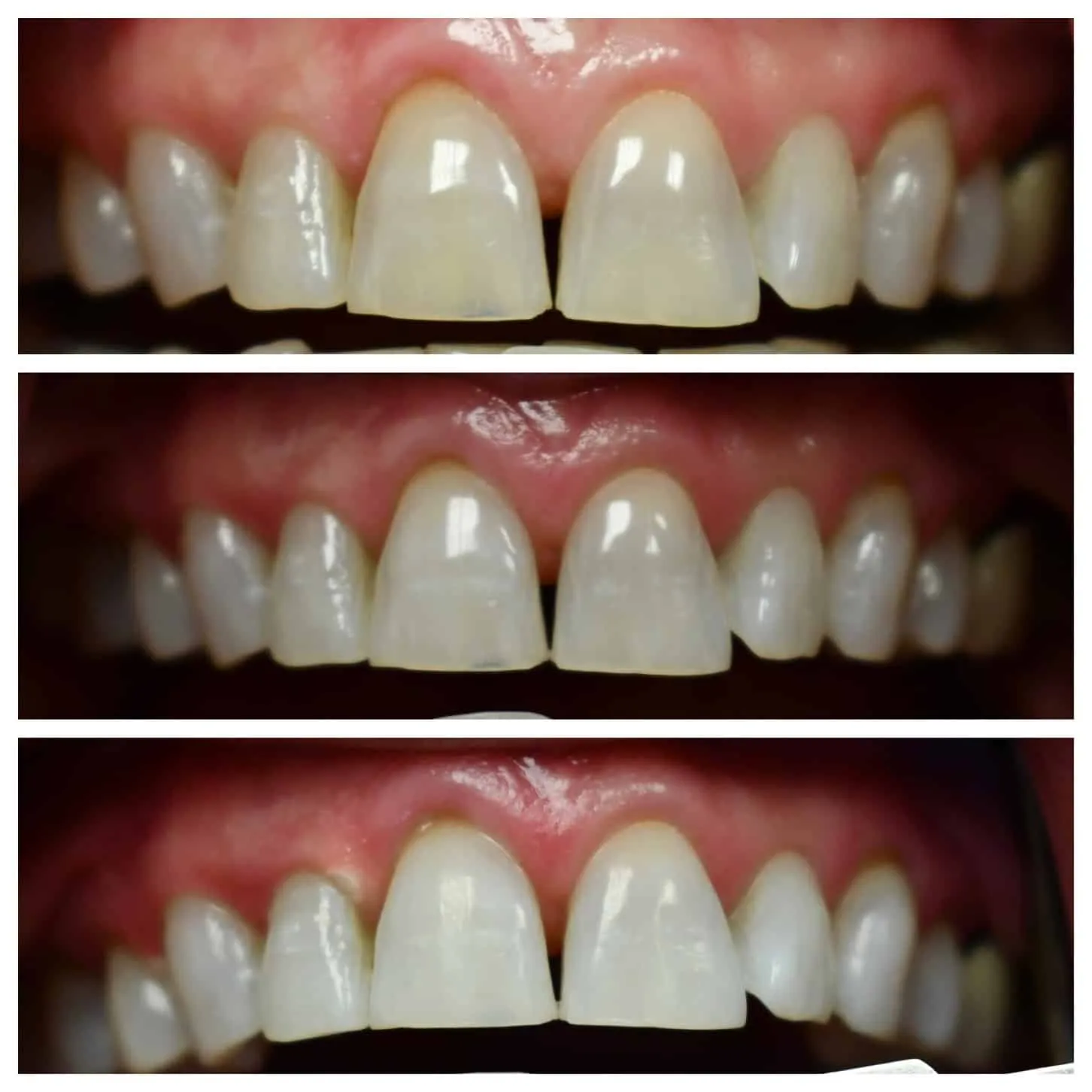 26941 teeth whitening collierville tn before after