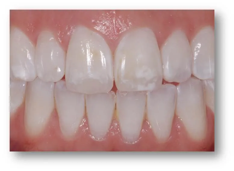 /img/26943-microabrasion-treatment.webp