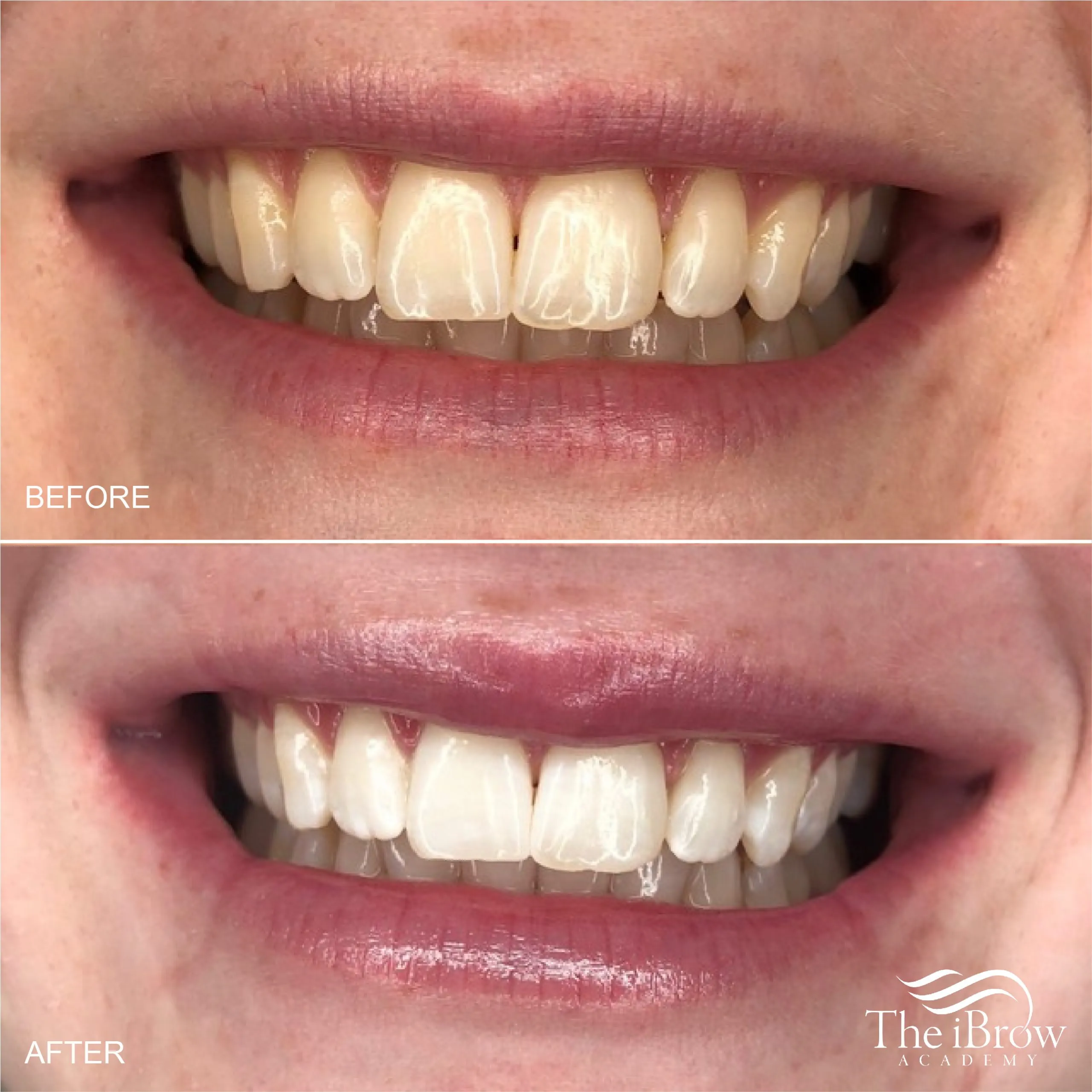 26946 over the counter whitening
