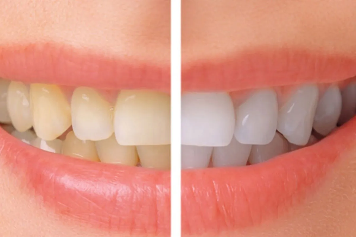 26946 professional teeth whitening