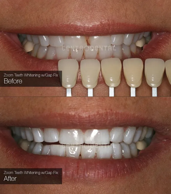 26947 zoom whitening blotchy teeth 2