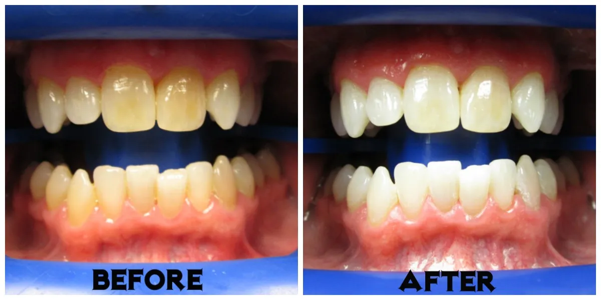 26947 zoom whitening blotchy teeth 3